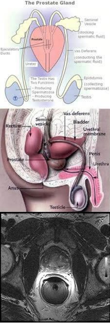Diagrams of male reproductive organ and an MR scan of the prostate