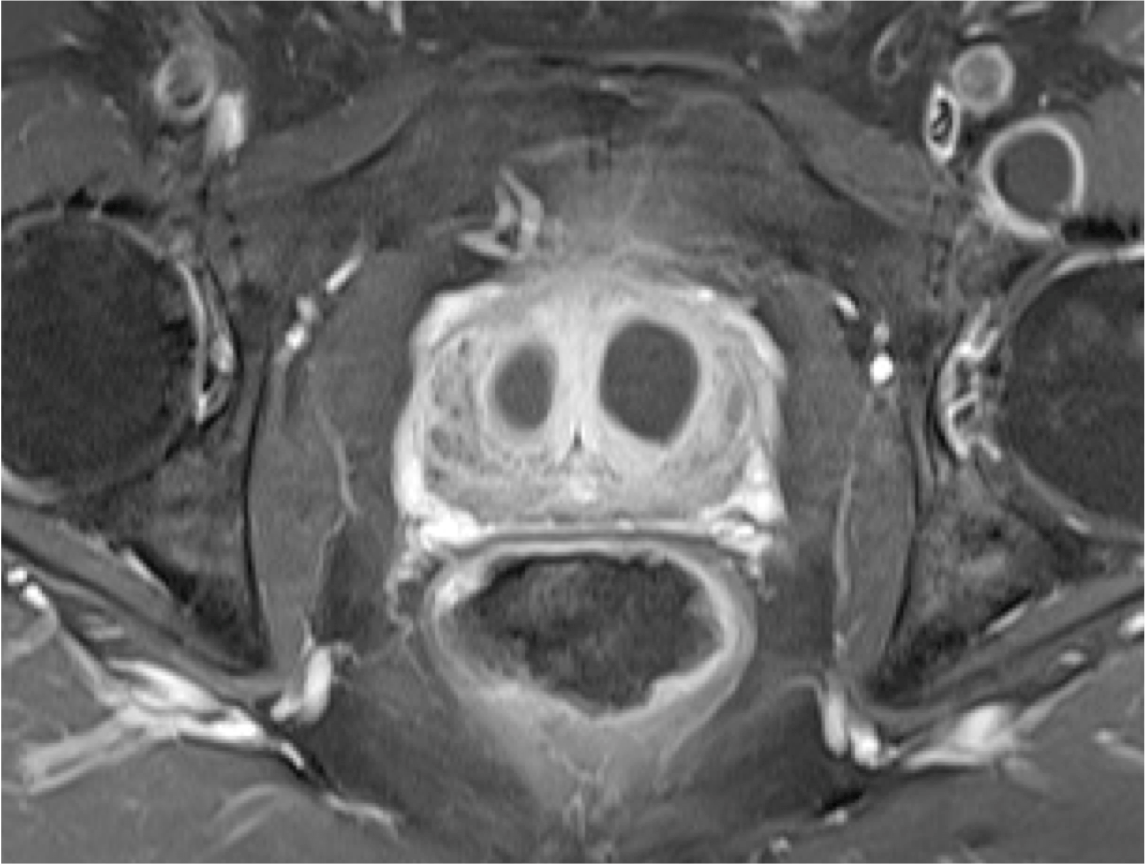 Scan of the prostate