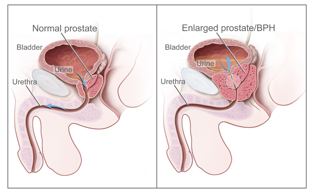 Overview of normal and enlarged prostate